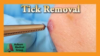 Dead Tick Removal  Auburn Medical Group [upl. by Eicul]