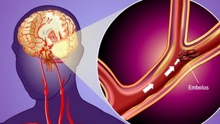 Risk Factors for Heart Disease [upl. by Jewel]