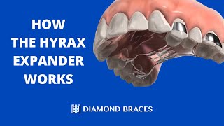 How The Hyrax Expander Works [upl. by Fox]