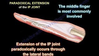 Lumbrical Plus Finger  Everything You Need To Know  Dr Nabil Ebraheim [upl. by Eitsud]