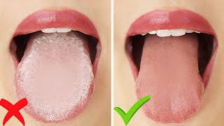 HOW TO Get Rid of White Tongue amp Bad Breath INSTANTLY [upl. by Elisha610]