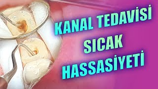 Kanal Tedavisi Sonrası Sıcak Ağrısı Olur mu [upl. by Nauqed488]