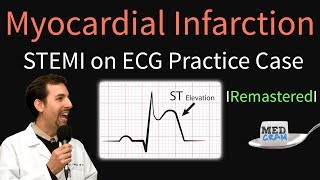 Myocardial Infarction  STEMI on ECG  Practice EKG [upl. by Jenness]