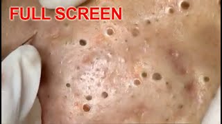 LARGE Blackheads Removal  Best Pimple Popping Videos [upl. by Kifar]