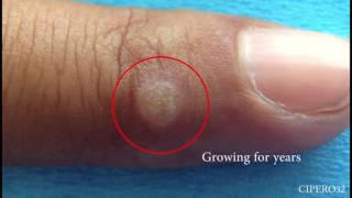 Wart Removal  Cryotherapy [upl. by Yeclek]