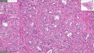 Prostatic Adenocarcinoma  Histopathology [upl. by Yerak]