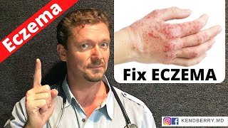 Is this Causing Your ECZEMA Easy Way to Tell 2024 [upl. by Charis]