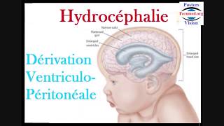 Hydrocéphalie et dérivation ventriculopéritonéale du liquide cérébrospinal [upl. by Doner95]