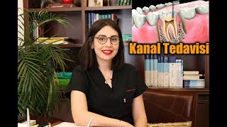 Kanal tedavisi  Nedir  Ne zaman ve nasıl yapılır [upl. by Gun]