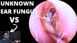 Ear Fungal Infection VS Audiologist [upl. by Akeirahs]