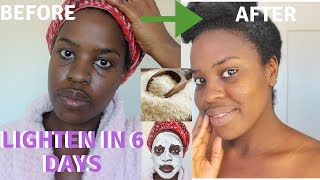 How I How i BRIGHTENED MY SKIN IN 6 DAYS REALISTIC and Natural way to reduce hyperpigmentation [upl. by Ahsiakal]