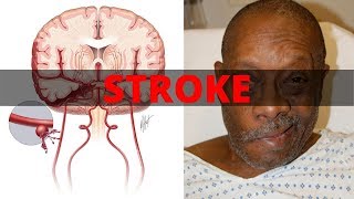 Stroke Syndromes MCA ACA ICA PCA Vertebrobasilar Artery Strokes  Pathophysiology [upl. by Lattimer]