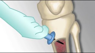 Placement of an Intraosseous Line by MKleinman  OPENPediatrics [upl. by Aldas]