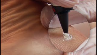 Plantar Wart Treatment [upl. by Nuris]