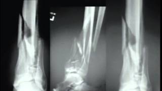 Pilon Fractures Management Options [upl. by Ahsatam]