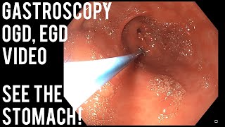 Gastroscopy  OGD  See inside the stomach [upl. by Eixor]