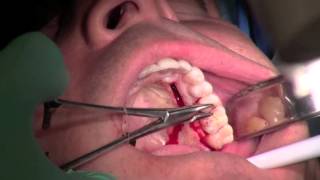 Palatal Gum Grafting [upl. by Akialam]