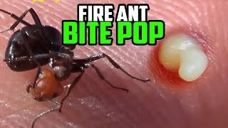 Fire Ant Bite Popped Under Microscope [upl. by Eenehs]