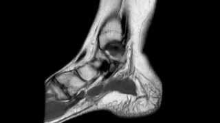 Ankle MRI anatomy [upl. by Naul]