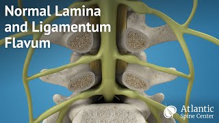 Normal Lamina and Ligamentum Flavum [upl. by Zel]