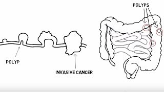 The Story of My Colorectal Cancer Diagnosis [upl. by Acireed]