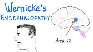 Wernickes Aphasia Fluent Aphasia  Neurology [upl. by Suhpoelc179]