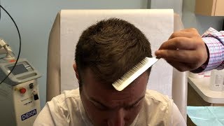 TOPICAL FINASTERIDE FOR MALE PATTERN HAIRLOSS  REAL PATIENT TESTIMONIAL [upl. by Sesmar]