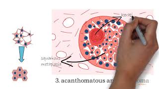 Ameloblastoma part 2 [upl. by Aneehsor]