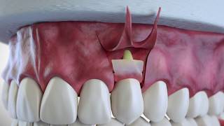 Subepithelial Connective Tissue Grafting [upl. by Kciv]