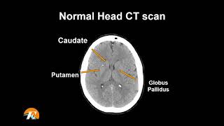 Normal Head CT Scan Anatomy Made Simple Neuroradiology [upl. by Sussi]