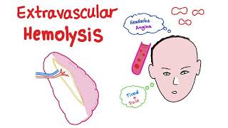 Extravascular Hemolysis [upl. by Ner91]