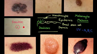 Melanocytic Lesions Part 2 [upl. by Narej217]