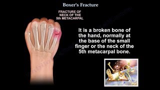 Boxers Fracture  Everything You Need To Know  Dr Nabil Ebraheim [upl. by Martita]