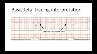 Interpreting Intrapartal fetal heart rate tracings [upl. by Annora]