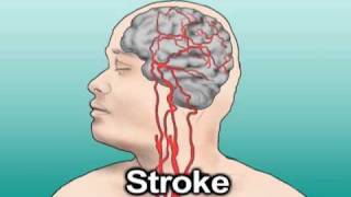 Stroke Education  Causes and Effects [upl. by Prunella]