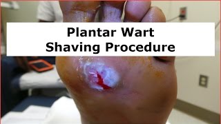 Plantar Wart Shaving Procedure [upl. by Obaza]