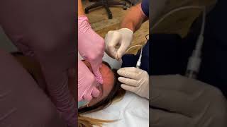 Treating Bulging Forehead Veins [upl. by Arfihs496]