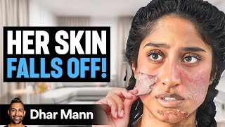 Girl Whose SKIN FALLS OFF  Dhar Mann Studios [upl. by Cox]